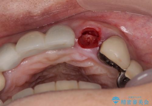 1DAYインプラント 土台から外れてしまった前歯を短期間で治療の治療中
