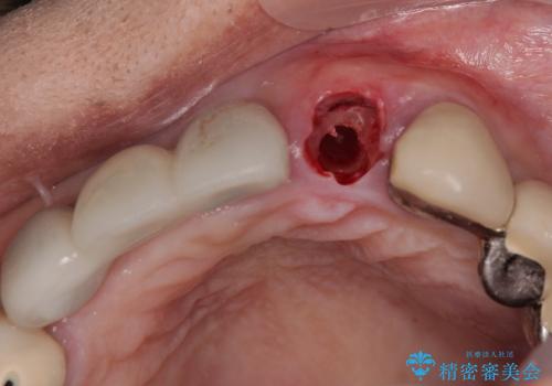 1DAYインプラント 土台から外れてしまった前歯を短期間で治療の治療後