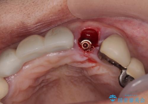 1DAYインプラント 土台から外れてしまった前歯を短期間で治療の治療中