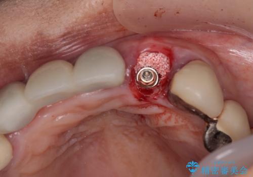 1DAYインプラント 土台から外れてしまった前歯を短期間で治療の治療中