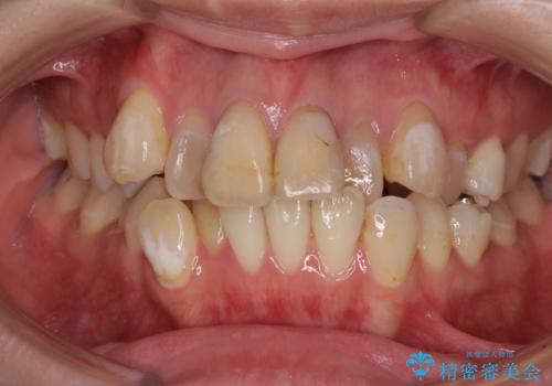 気になる八重歯と変色した前歯 抜歯矯正とセラミッククラウン治療の症例 治療前