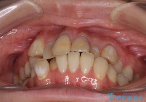 気になる八重歯と変色した前歯　抜歯矯正とセラミッククラウン治療の治療前