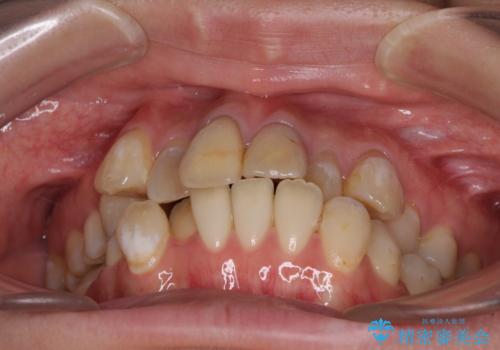 気になる八重歯と変色した前歯 抜歯矯正とセラミッククラウン治療の治療前