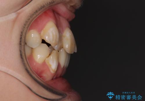 気になる八重歯と変色した前歯 抜歯矯正とセラミッククラウン治療の治療前