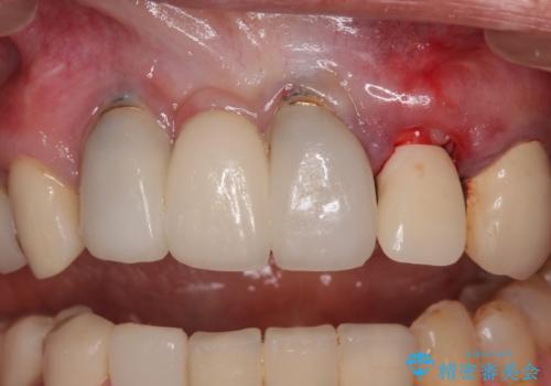 1DAYインプラント 土台から外れてしまった前歯を短期間で治療の治療中