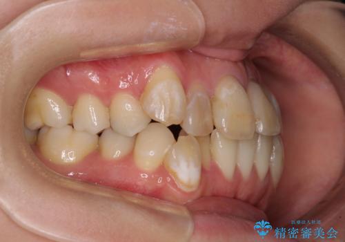気になる八重歯と変色した前歯 抜歯矯正とセラミッククラウン治療の治療前