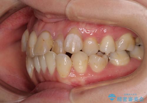 気になる八重歯と変色した前歯 抜歯矯正とセラミッククラウン治療の治療前