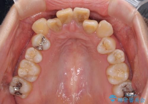 気になる八重歯と変色した前歯 抜歯矯正とセラミッククラウン治療の治療前