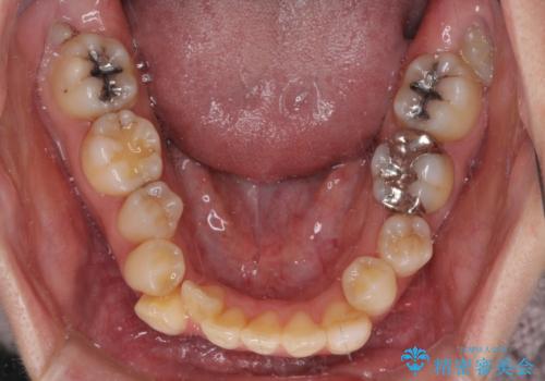 気になる八重歯と変色した前歯 抜歯矯正とセラミッククラウン治療の治療前