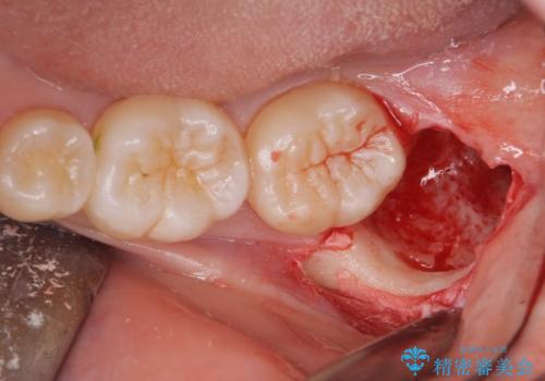 左の親知らず抜歯したい。の治療後