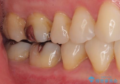 銀歯をやり替えたい フルジルコニアクラウン・ゴールドインレー修復の治療前