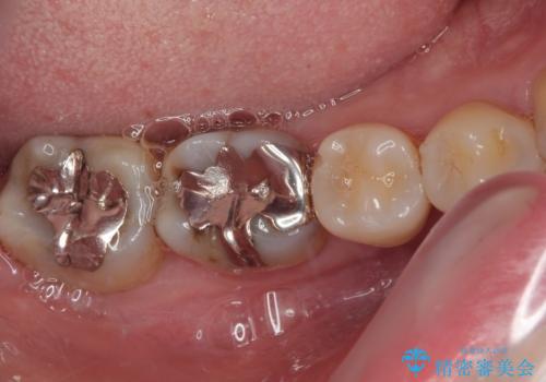 銀歯をやり替えたい フルジルコニアクラウン・セラミックインレー修復の治療前