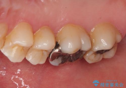 銀歯をやり替えたい フルジルコニアクラウン・ゴールドインレー修復の治療前