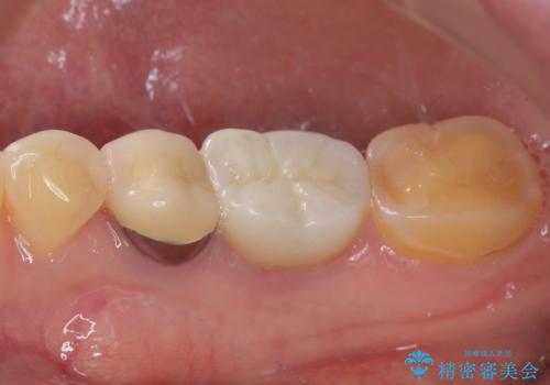 検診で見つかった齲蝕のセラミックインレー修復の治療後