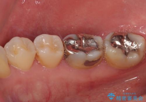 銀歯をやり替えたい フルジルコニアクラウン・セラミックインレー修復の治療前