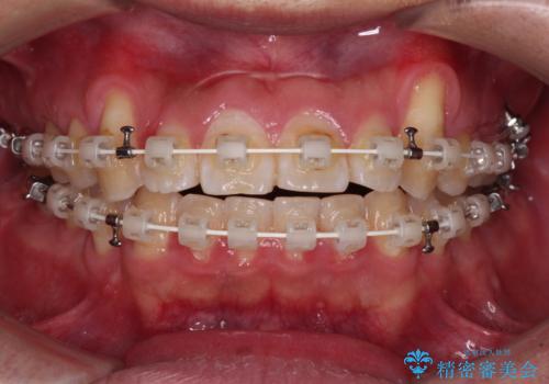 目立つ八重歯を非抜歯矯正で整える 目立たないワイヤー矯正の治療中