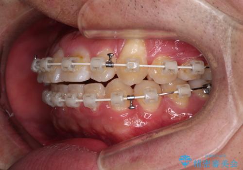 目立つ八重歯を非抜歯矯正で整える 目立たないワイヤー矯正の治療中