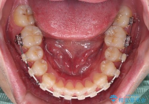 目立つ八重歯を非抜歯矯正で整える 目立たないワイヤー矯正の治療中