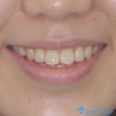 再矯正 開咬に後戻りした歯列をインビザラインで改善の治療前(顔貌)