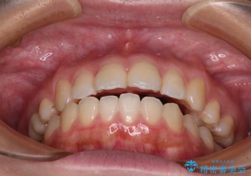 再矯正 開咬に後戻りした歯列をインビザラインで改善の治療前