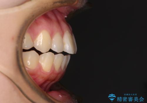 再矯正 開咬に後戻りした歯列をインビザラインで改善の治療前