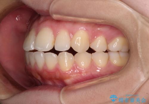 再矯正 開咬に後戻りした歯列をインビザラインで改善の治療前