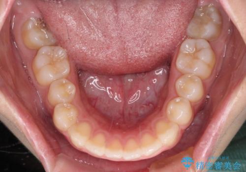 再矯正 開咬に後戻りした歯列をインビザラインで改善の治療前