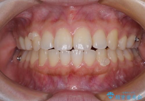 再矯正 開咬に後戻りした歯列をインビザラインで改善の治療中