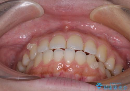 再矯正 開咬に後戻りした歯列をインビザラインで改善の治療中