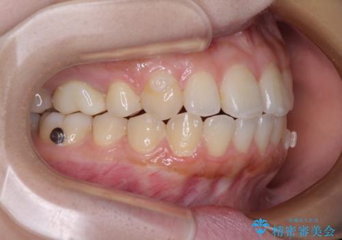 再矯正 開咬に後戻りした歯列をインビザラインで改善の治療中