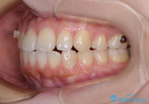 再矯正 開咬に後戻りした歯列をインビザラインで改善の治療中