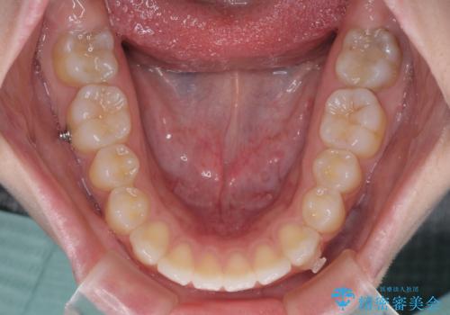 再矯正 開咬に後戻りした歯列をインビザラインで改善の治療中