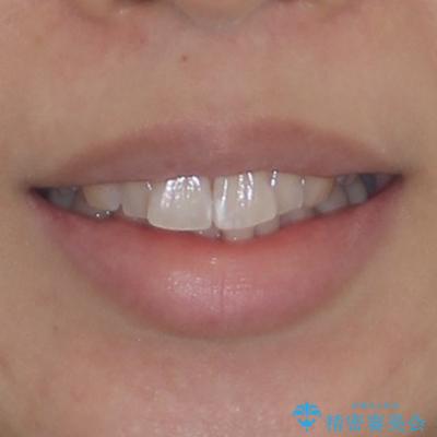 前に飛び出して目立っている前歯を整える インビザライン矯正治療の治療前(顔貌)