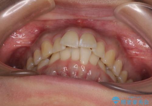 前に飛び出して目立っている前歯を整える インビザライン矯正治療の治療前