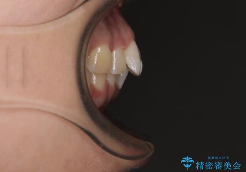 前に飛び出して目立っている前歯を整える インビザライン矯正治療の治療前
