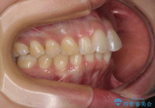 前に飛び出して目立っている前歯を整える インビザライン矯正治療の治療前