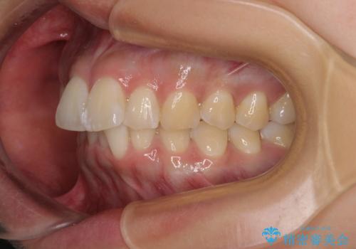 前に飛び出して目立っている前歯を整える インビザライン矯正治療の治療前