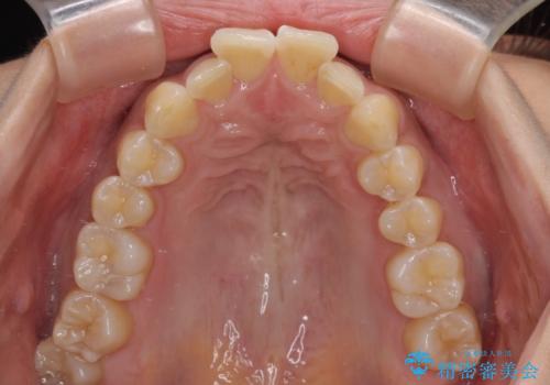 前に飛び出して目立っている前歯を整える インビザライン矯正治療の治療前