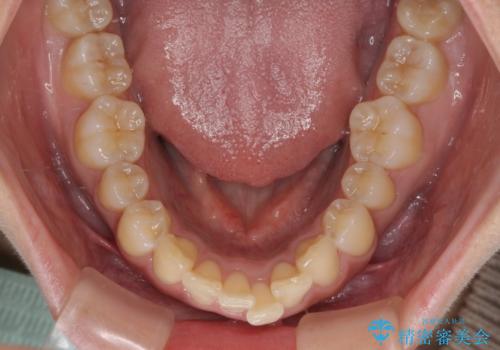 前に飛び出して目立っている前歯を整える インビザライン矯正治療の治療前