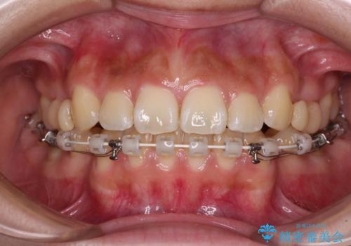 飛び出ている出っ歯を治したい 目立たない装置での抜歯矯正治療の治療中