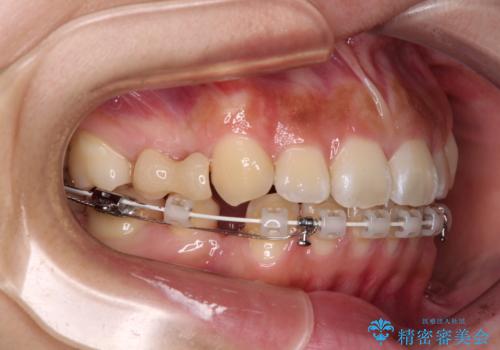 飛べ出ている出っ歯を治したい　目立たない装置での抜歯矯正治療の治療中