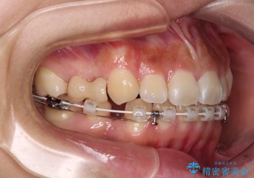 飛び出ている出っ歯を治したい 目立たない装置での抜歯矯正治療の治療中