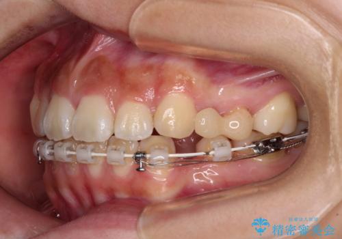 飛べ出ている出っ歯を治したい　目立たない装置での抜歯矯正治療の治療中