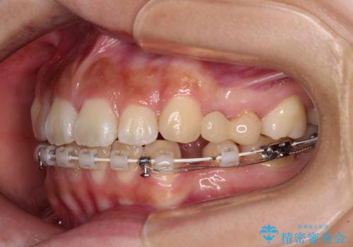 飛び出ている出っ歯を治したい 目立たない装置での抜歯矯正治療の治療中