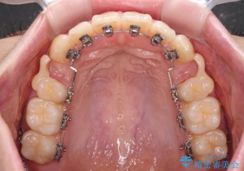 飛び出ている出っ歯を治したい 目立たない装置での抜歯矯正治療の治療中