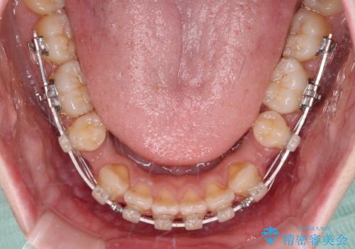 飛び出ている出っ歯を治したい 目立たない装置での抜歯矯正治療の治療中