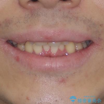 前歯のデコボコを治したい ワイヤー装置での非抜歯矯正の治療前(顔貌)