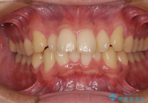 前歯のデコボコを治したい ワイヤー装置での非抜歯矯正の症例 治療前