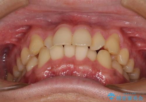 前歯のデコボコを治したい ワイヤー装置での非抜歯矯正の治療前