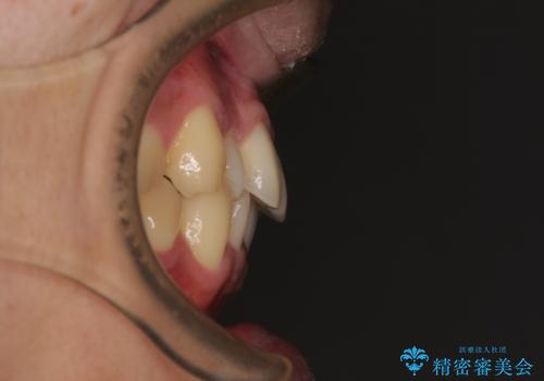 前歯のデコボコを治したい ワイヤー装置での非抜歯矯正の治療前